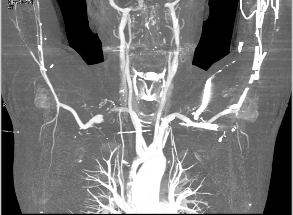 Pseudoaneurysm Right Subclavian Artery - CTisus CT Scan