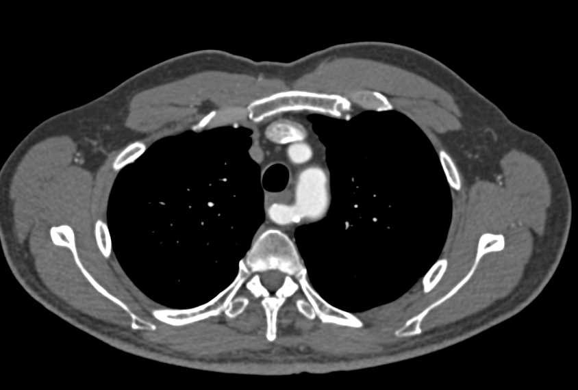 Aberrant Right Subclavian Artery - CTisus CT Scan