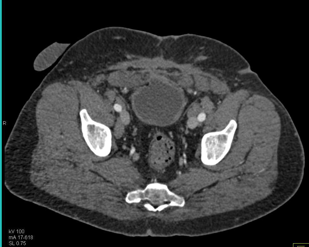 CTA Runoff with Mild Vascular Disease - CTisus CT Scan