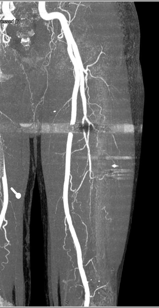 GSW Left Thigh Without Vascular Injury - CTisus CT Scan