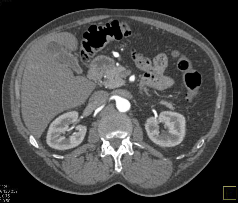 Subtle Aneurysm off the Gastroduodenal Artery (GDA) Seen Only on CTA 3D Images - CTisus CT Scan