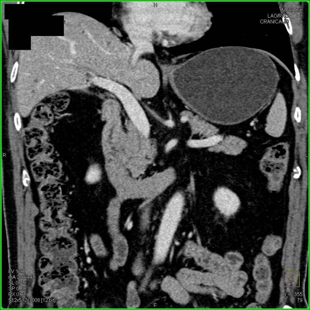 Pseudo clot in the Portal Vein - CTisus CT Scan