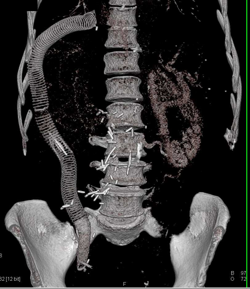 Renal Cell Carcinoma Invaded Inferior Vena Cava (IVC) and a Graft to Bypass the IVC was Created - CTisus CT Scan