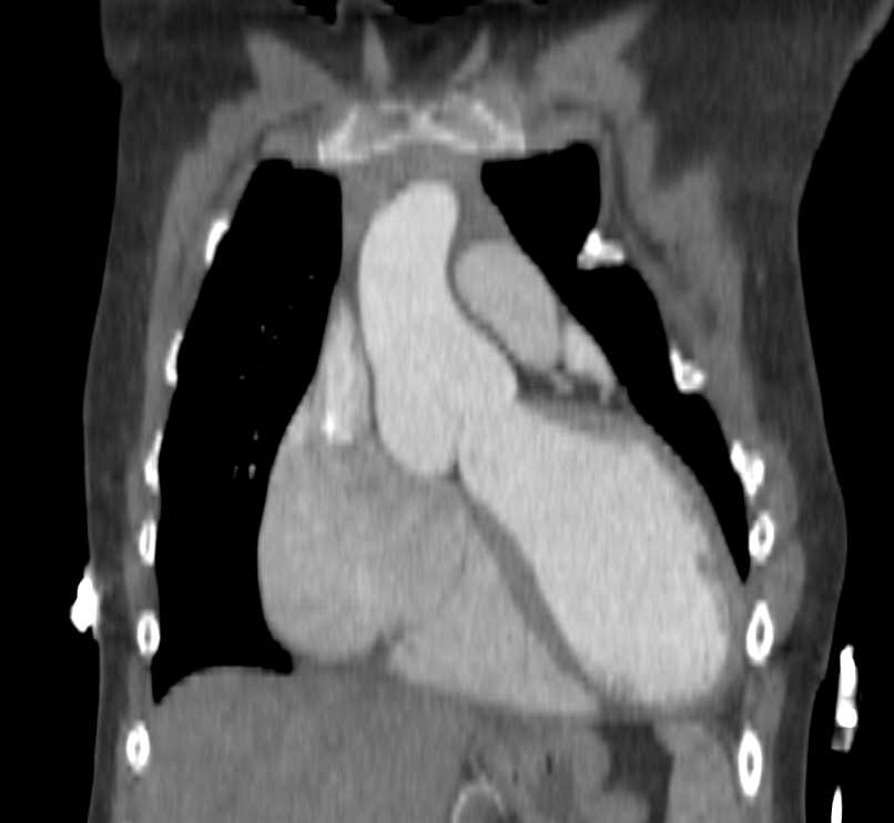 Markedly Dilated Root and Sinus of Valsalva in Marfan Syndrome. - CTisus CT Scan