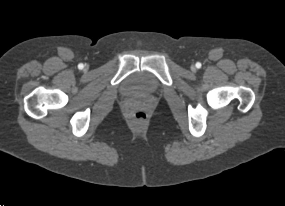 CTA Runoff with Right Popliteal Artery Occlusion - CTisus CT Scan