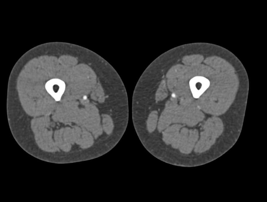 CTA Runoff with Right Popliteal Artery Occlusion - CTisus CT Scan