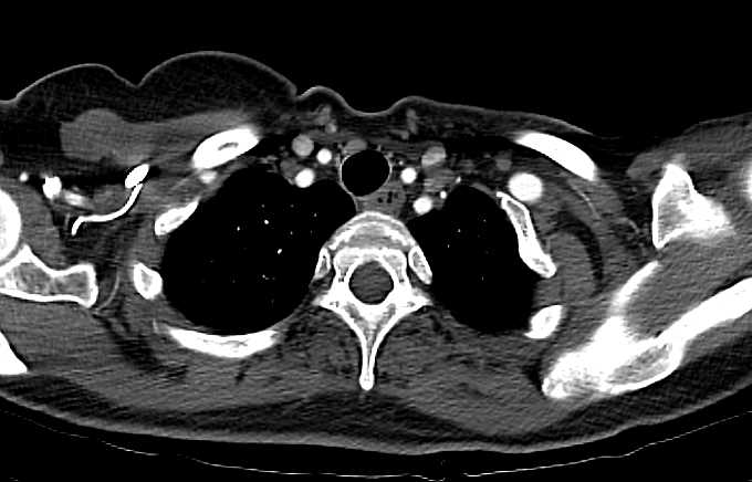 Pseudoaneurysm Left Subclavian Artery - CTisus CT Scan