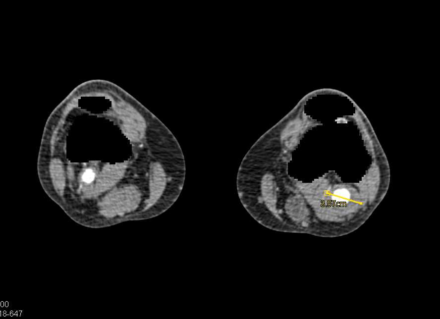 CTA with Left Popliteal Artery Aneurysm - CTisus CT Scan