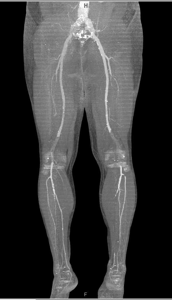 CTA Runoff with Left Popliteal Artery Aneurysm - CTisus CT Scan