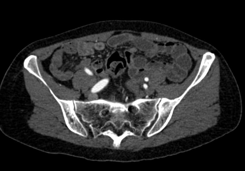 Right Pelvic Arteriovenous Malformation (AVM) S/P Embolization - CTisus CT Scan