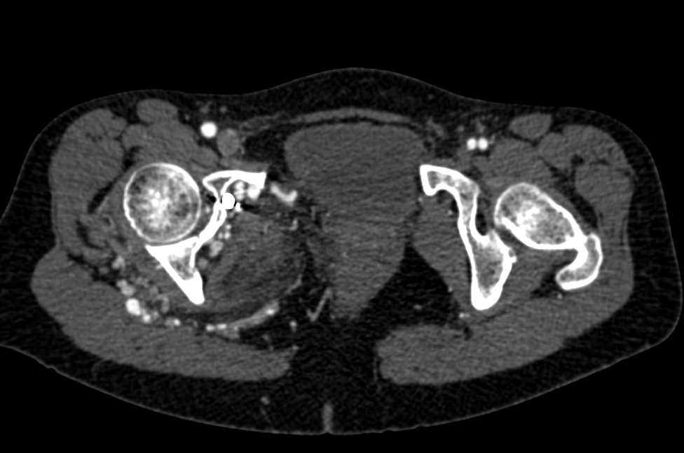 Right Pelvic Arteriovenous Malformation (AVM) S/P Embolization - CTisus CT Scan
