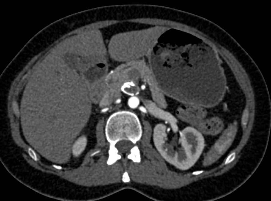 Superior Mesenteric Artery (SMA) Aneurysm - CTisus CT Scan