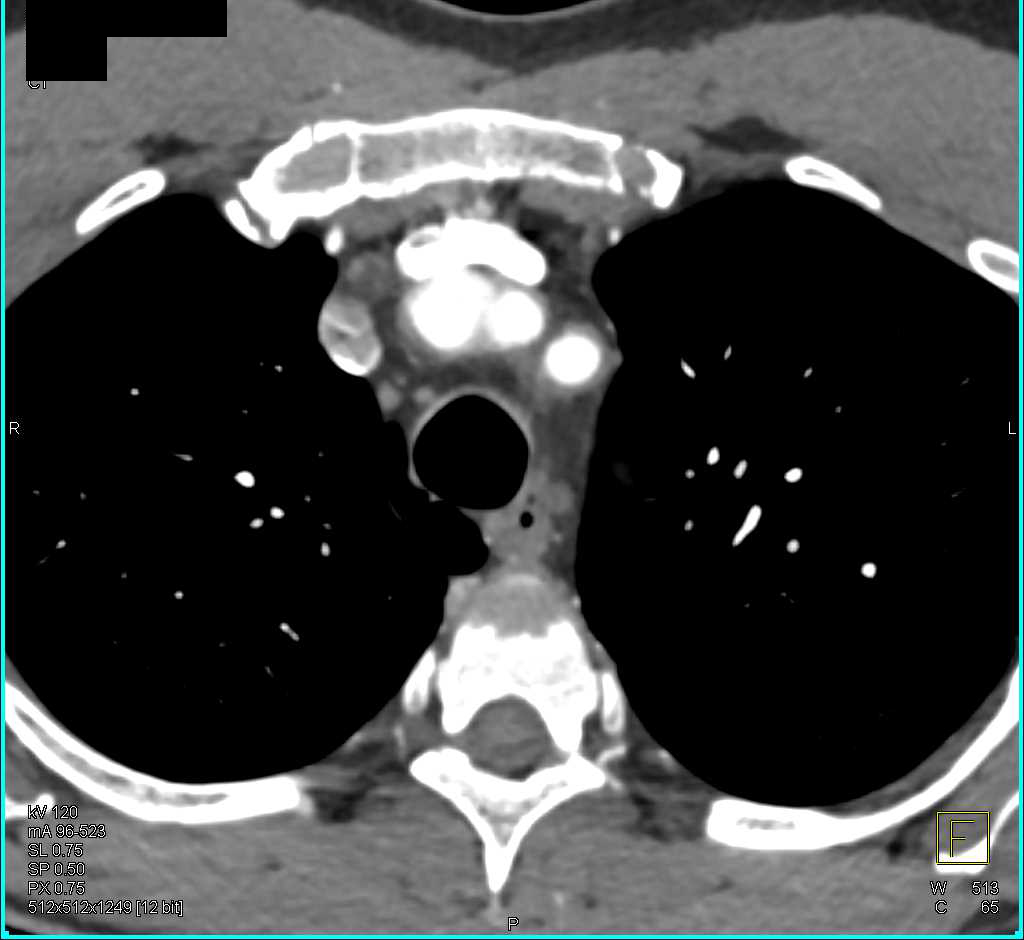 Takayasu's Arteritis Best Seen in Left Subclavian Artery and Abdominal Aorta - CTisus CT Scan