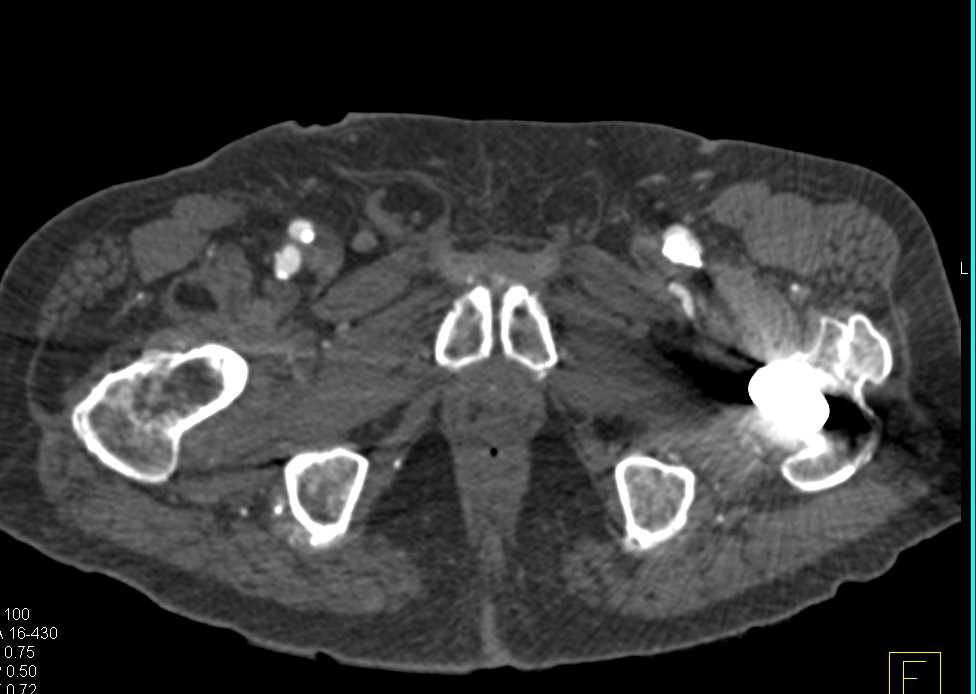 CTA Runoff with Peripheral Vascular Disease (PVD) and Superficial Femoral Artery (SFA) occlusions and Diseased Trifurcation Vessels - CTisus CT Scan