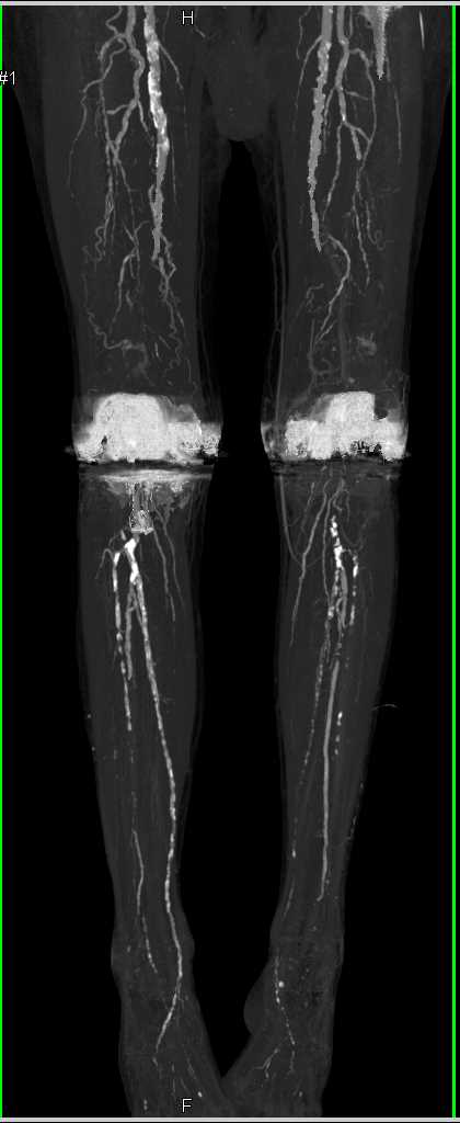 CTA Runoff with Peripheral Vascular Disease (PVD) and Superficial Femoral Artery (SFA) occlusions and Diseased Trifurcation Vessels and Artifacts off Total Knee Replacements - CTisus CT Scan
