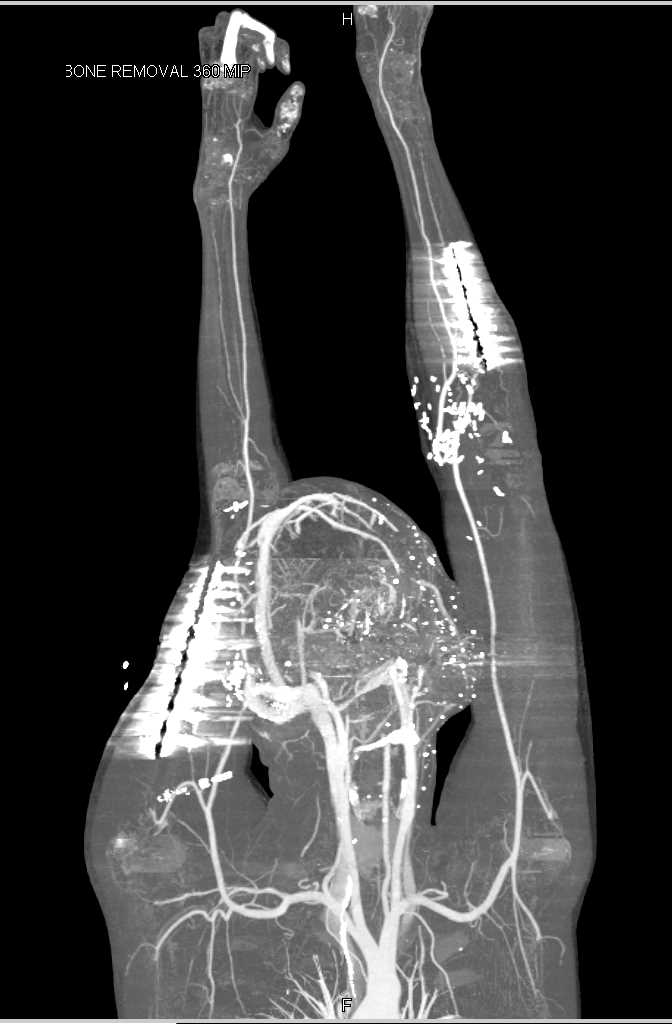 CTA Map Upper Extremity Following Repair with Dual Energy CTA - CTisus CT Scan