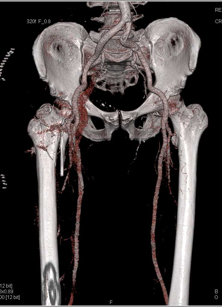 CT Runoff with Arteriovenous (AV) Fistulae on the Right Side - CTisus CT Scan