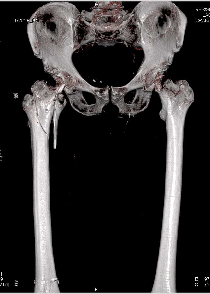 CT Runoff with Arteriovenous (AV) Fistulae on the Right Side - CTisus CT Scan