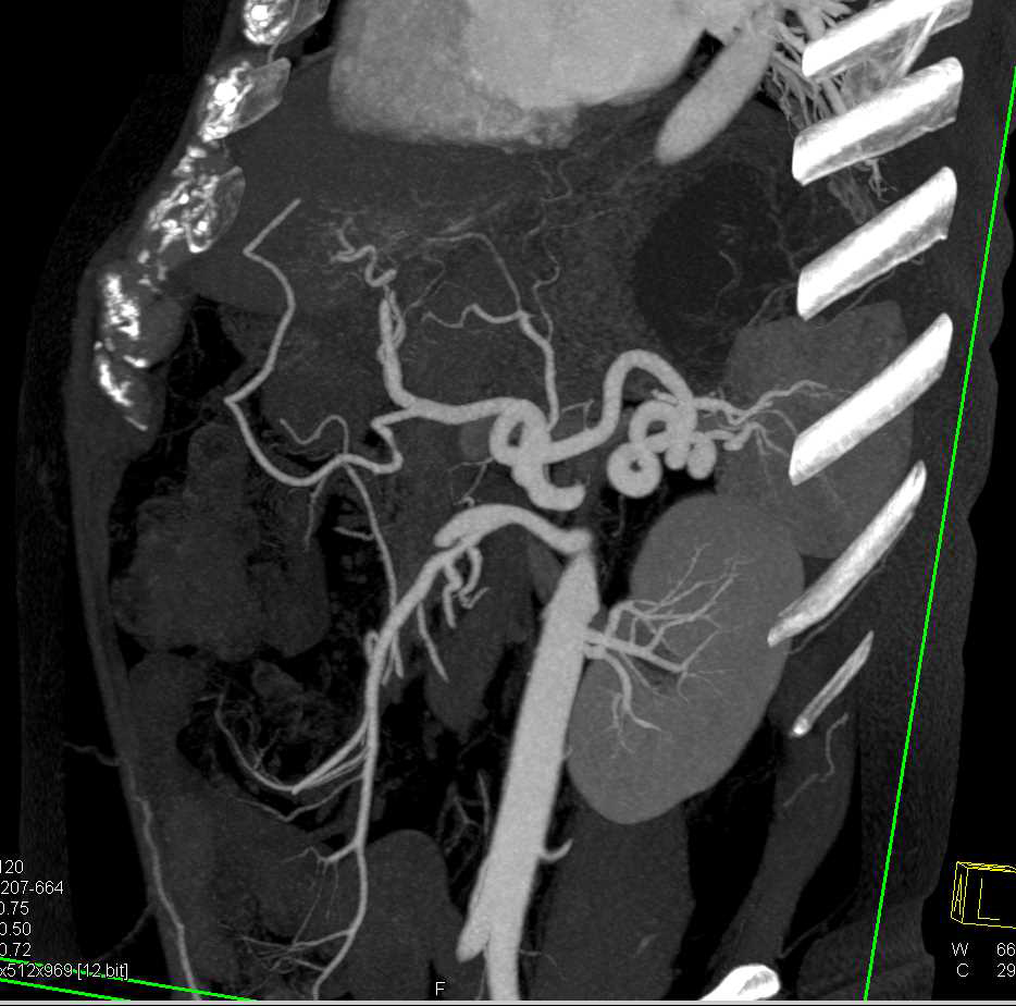 Aneurysm of the Celiac Artery - CTisus CT Scan