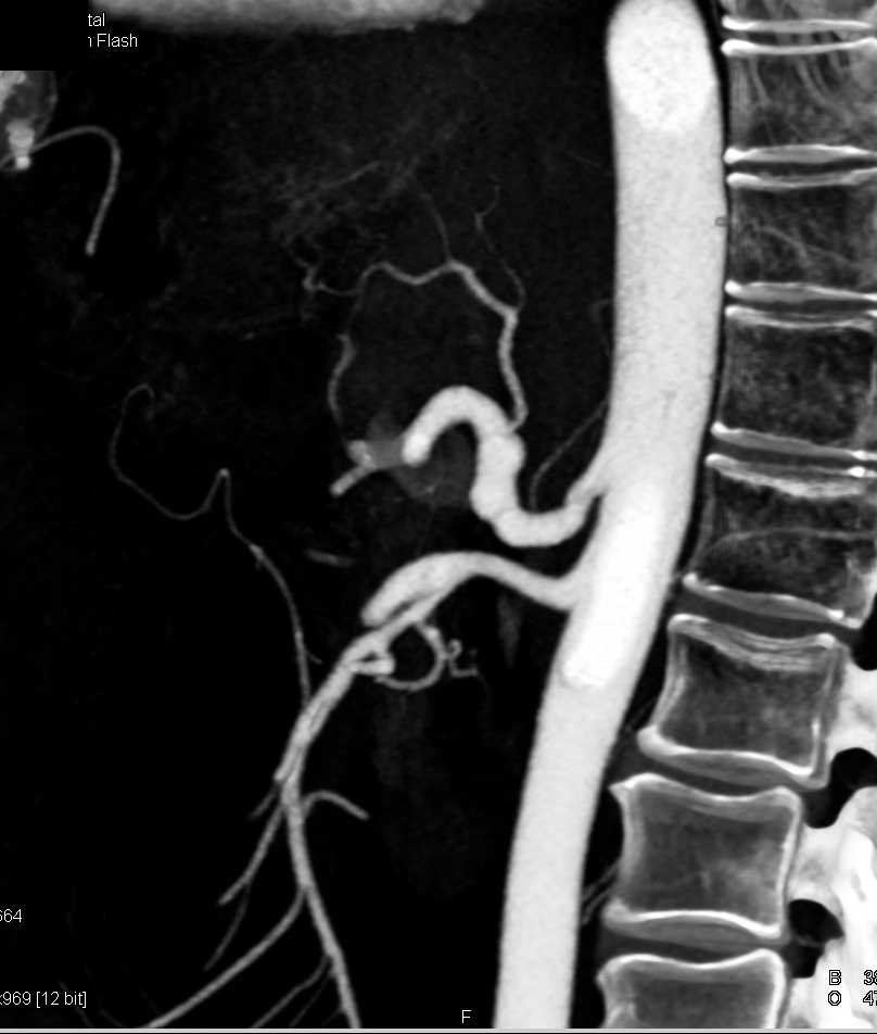 Aneurysm of the Celiac Artery in 3D - CTisus CT Scan