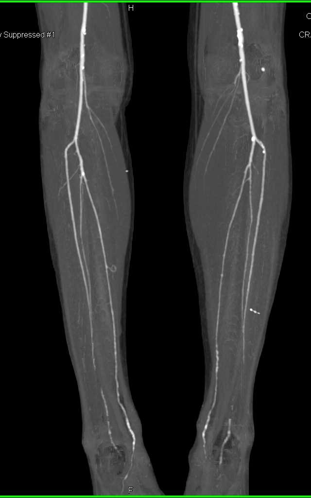 Dual Energy with Occluded Right Common Iliac Artery and Artifact by the Left Common Iliac Artery - CTisus CT Scan