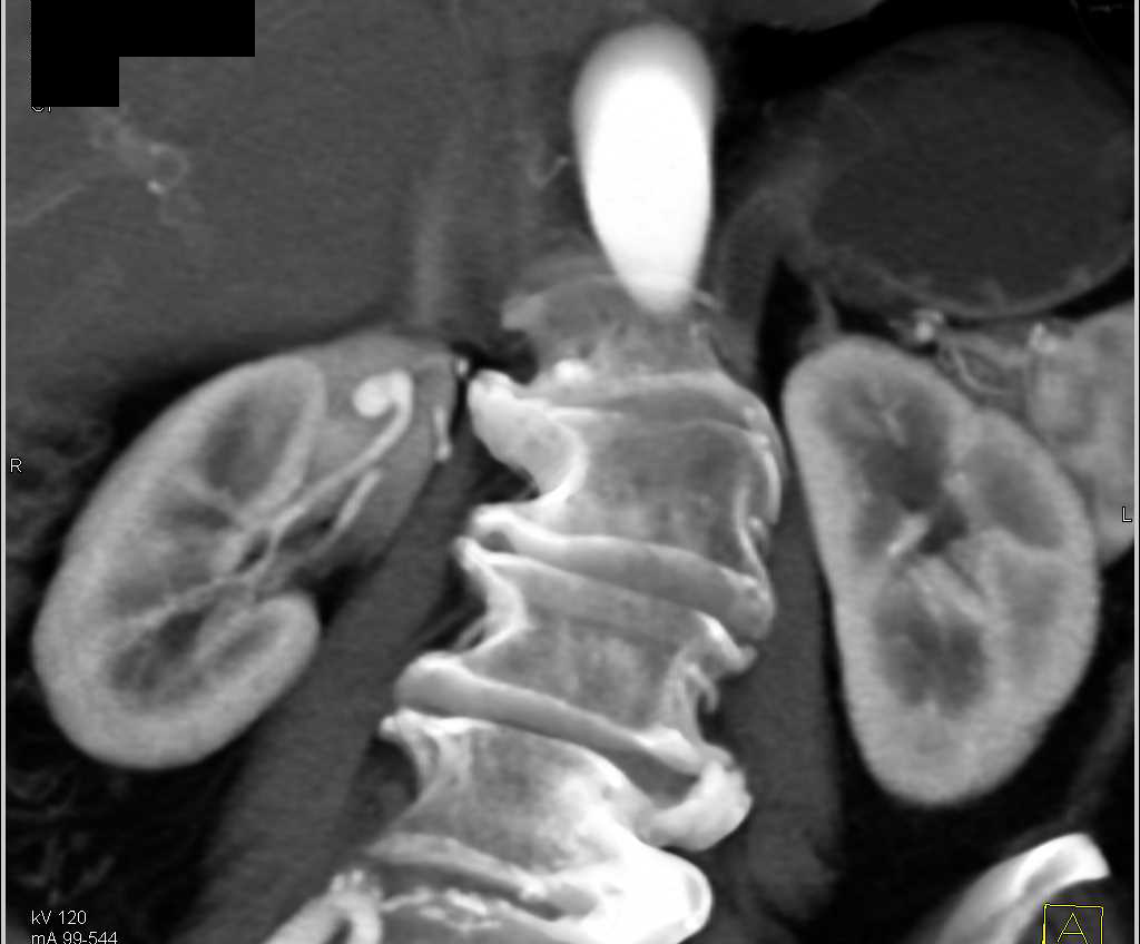 Right Renal Artery Aneurysm - CTisus CT Scan