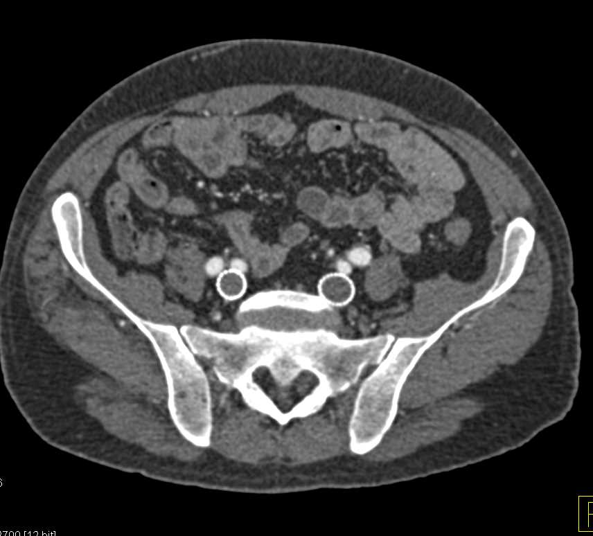 CTA with Arterial Phase Imaging and No Venous Flow in 3D - CTisus CT Scan