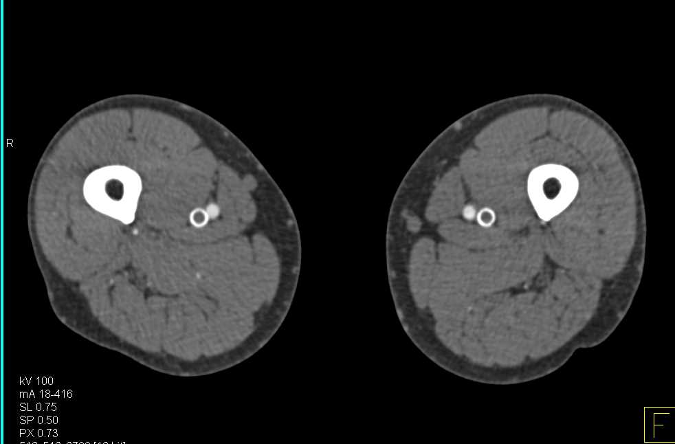 CTA with Arterial Phase Imaging and No Venous Flow in 3D in Stents - CTisus CT Scan