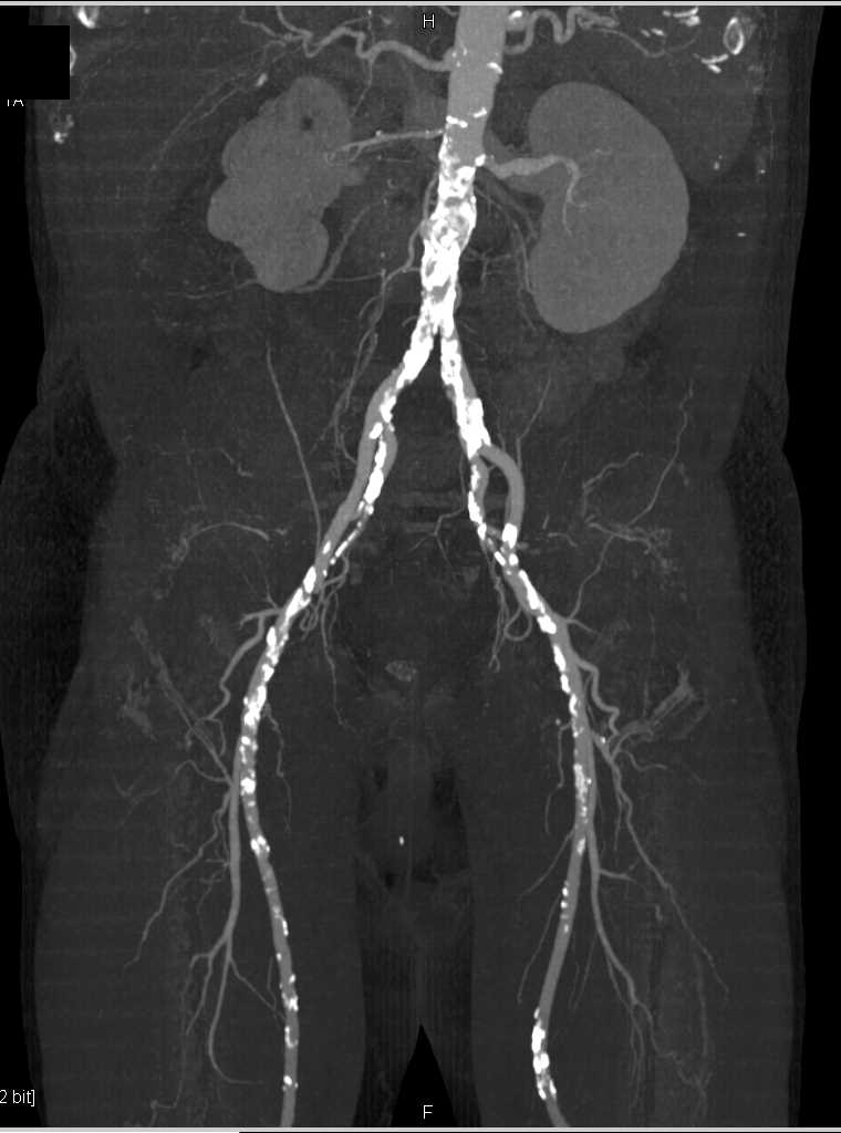 DE CTA Runoff with Extensive Calcified Plaque in all Vessels Especially Superficial Femoral Artery (SFA) and Trifurcation Vessels - CTisus CT Scan