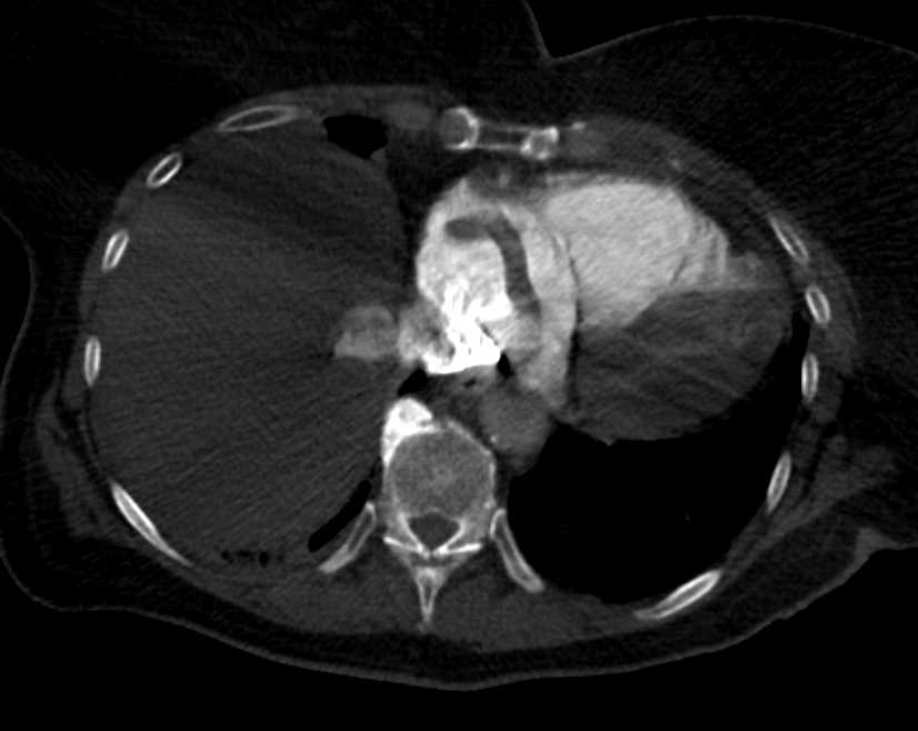 Extensive Thrombi in Heart and Pulmonary Arteries - CTisus CT Scan