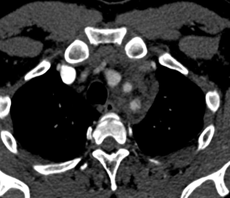 Takayasu's Arteritis Best Seen in Left Subclavian Artery - CTisus CT Scan