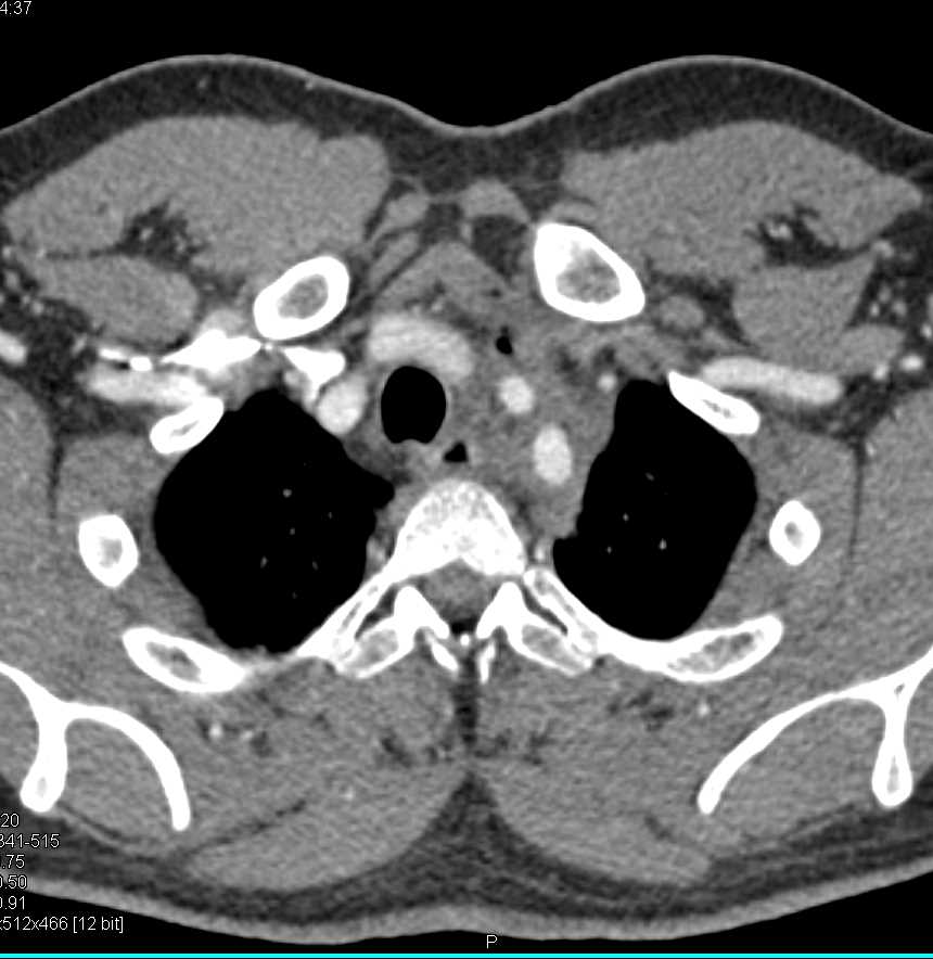 Takayasu's Arteritis Best Seen in Left Subclavian Artery - CTisus CT Scan