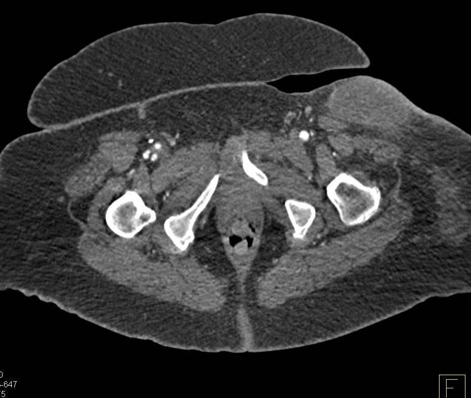 CTA DE with Peripheral Vascular Disease (PVD) and Bleed Left Thigh - CTisus CT Scan