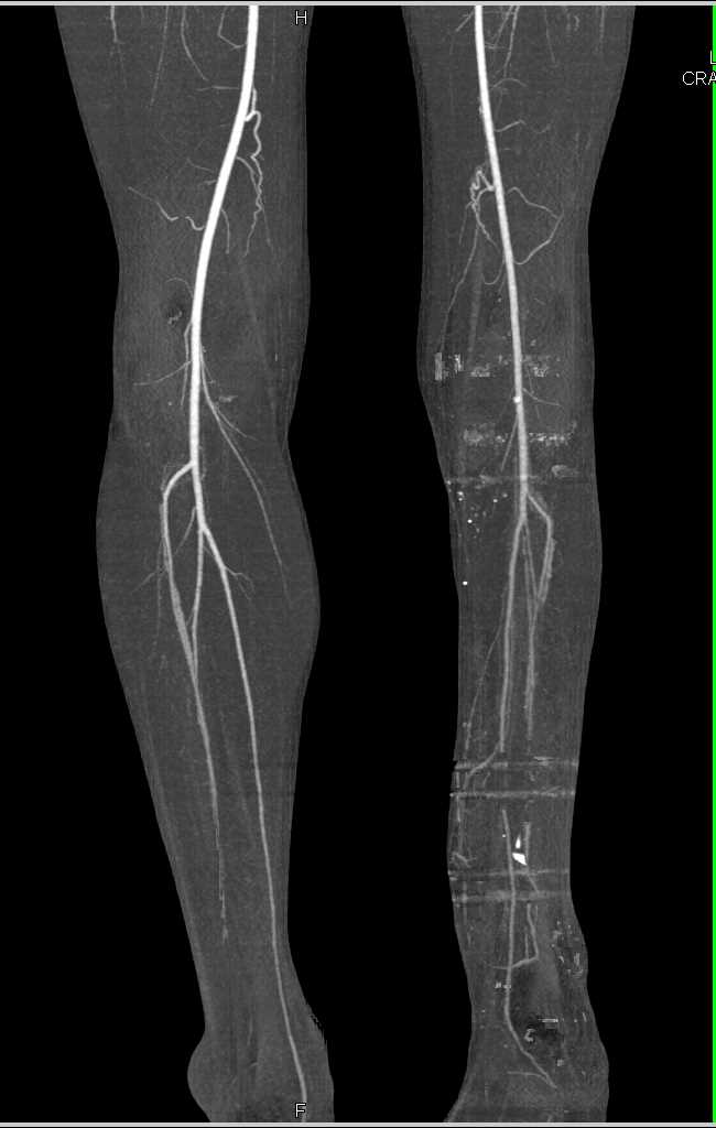 Dual Energy CTA with Prior Fractures Distal Left Tibia and Fibula and Peripheral Vascular Disease (PVD) - CTisus CT Scan