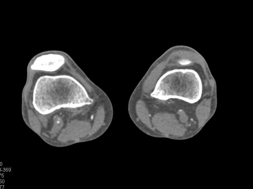 CTA Runoff with Popliteal Artery Occlusion - CTisus CT Scan