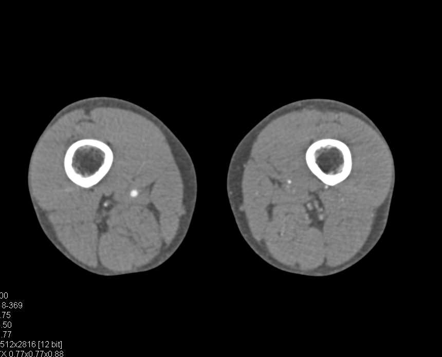 CTA with Occlusion of Left Superficial Femoral Artery (SFA) above the Knee - CTisus CT Scan