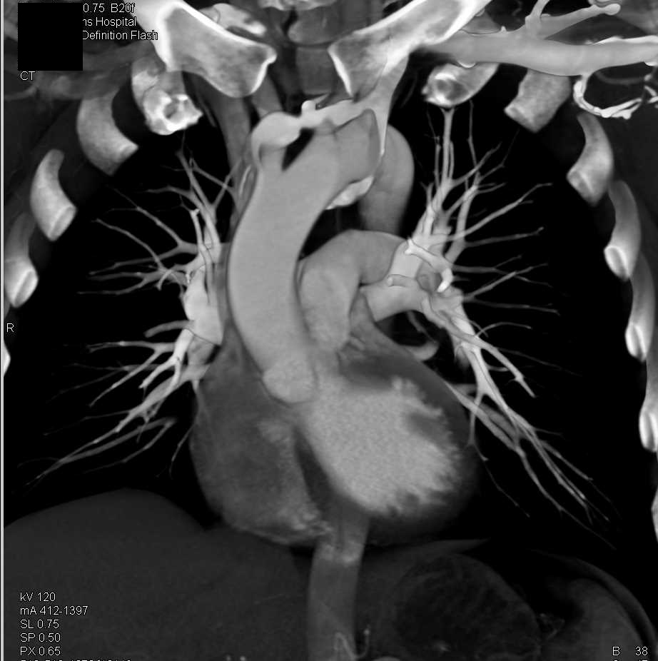 Left Innominate Vein Tracks Behind the Aorta - CTisus CT Scan