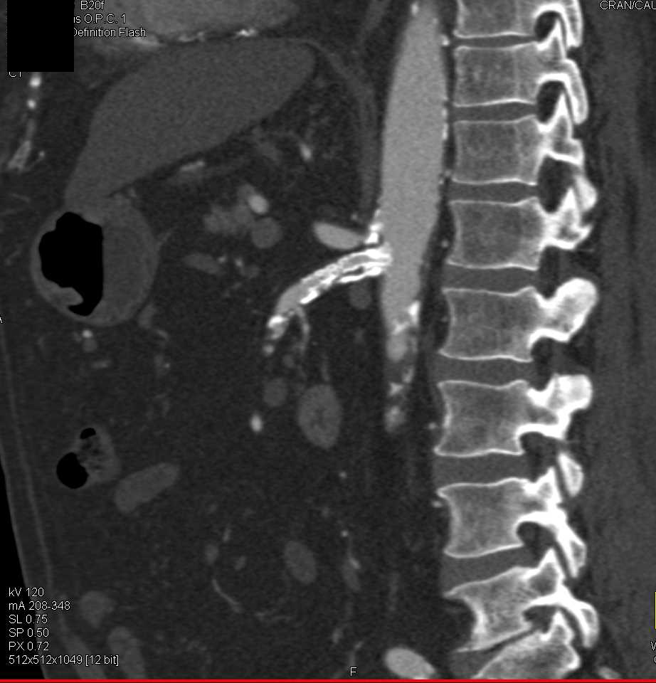 Patent Stent in the SMA - CTisus CT Scan