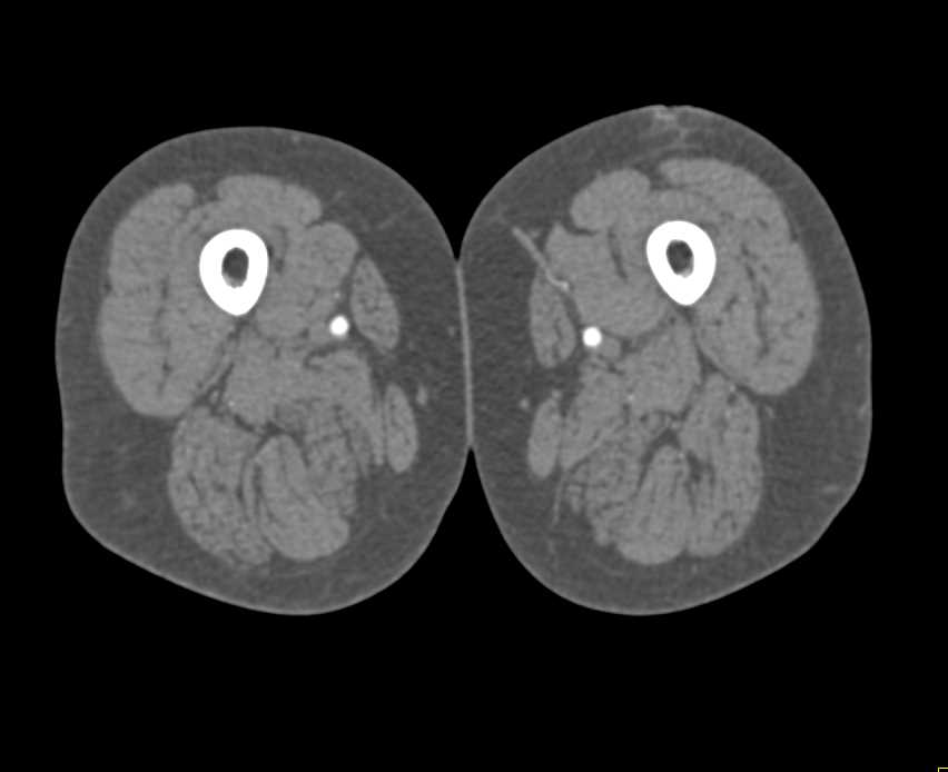 CTA Runoff with Mild Peripheral Vascular Disease (PVD) - CTisus CT Scan