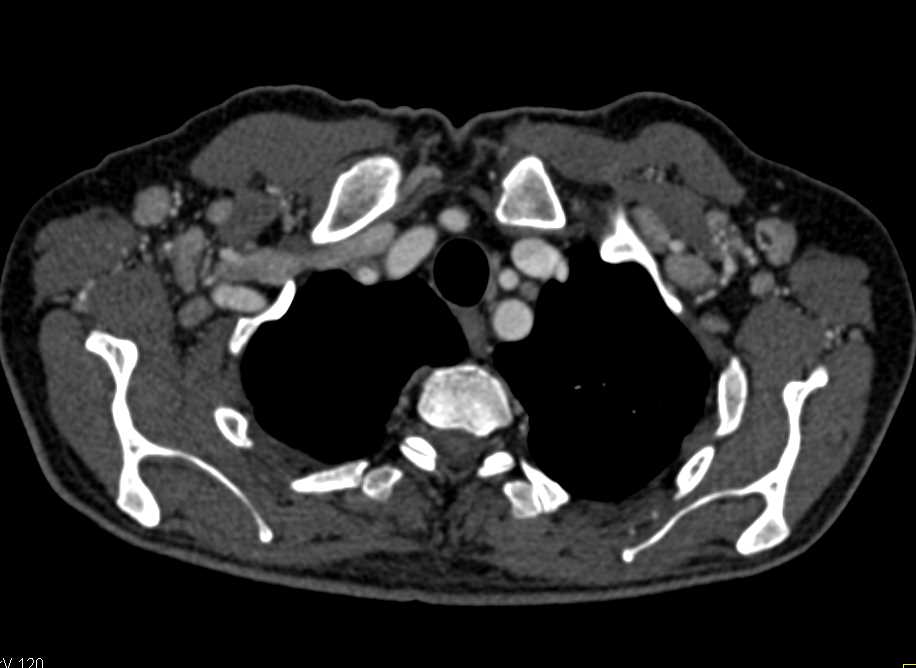 Type B Dissection in a Marfan Patient - CTisus CT Scan