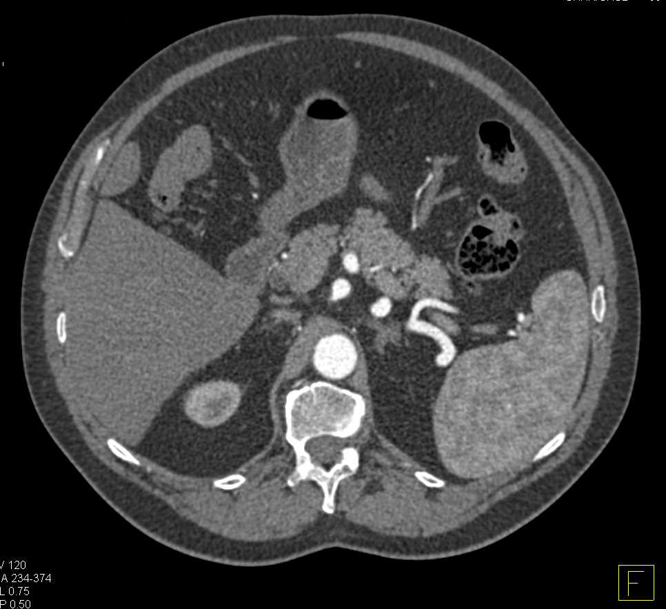 Spontaneous Dissection in the SMA - CTisus CT Scan