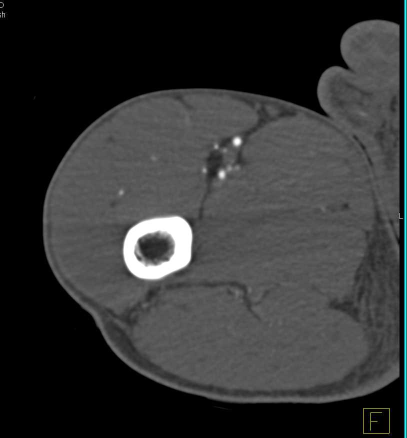 CTA with Laceration Superficial Femoral Artery (SFA) with Mid-Thigh Arteriovenous (AV) Fistulae - CTisus CT Scan