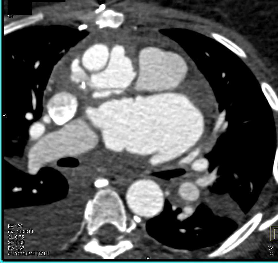 Endoleak Following Repair of Type A Dissection - CTisus CT Scan