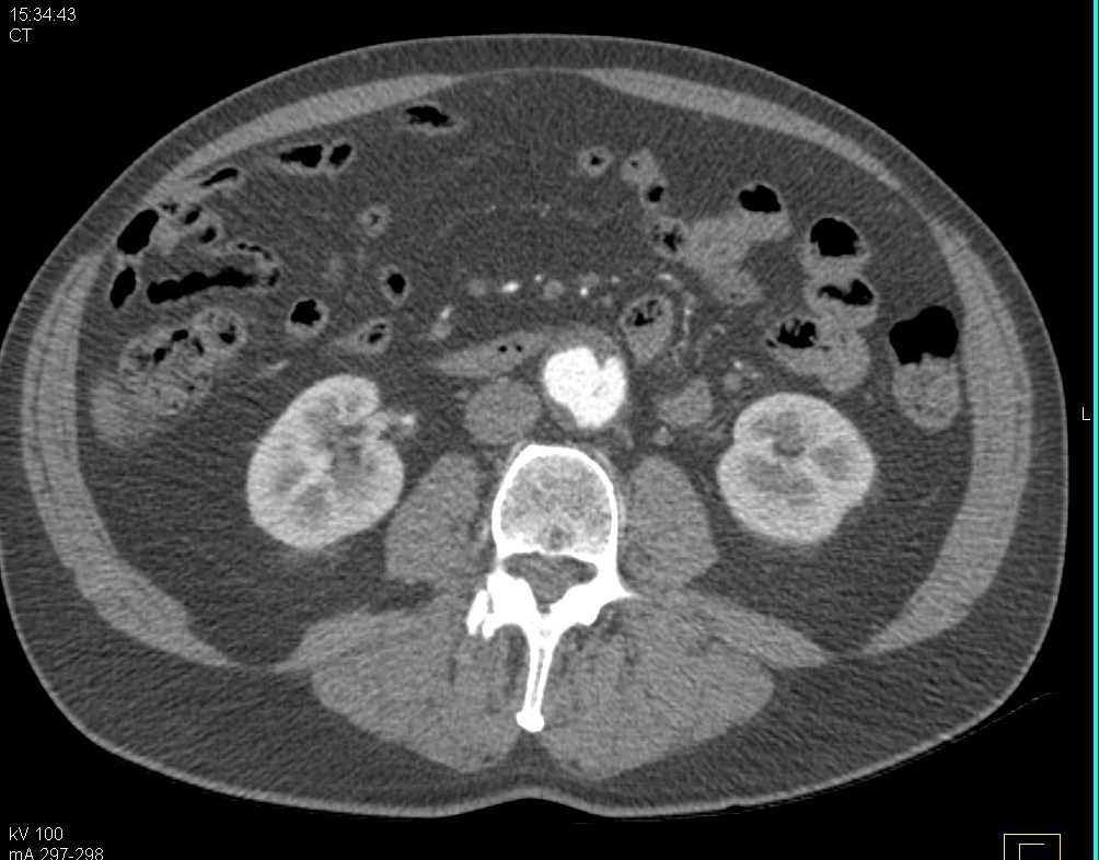 Type B Aortic Dissection - CTisus CT Scan