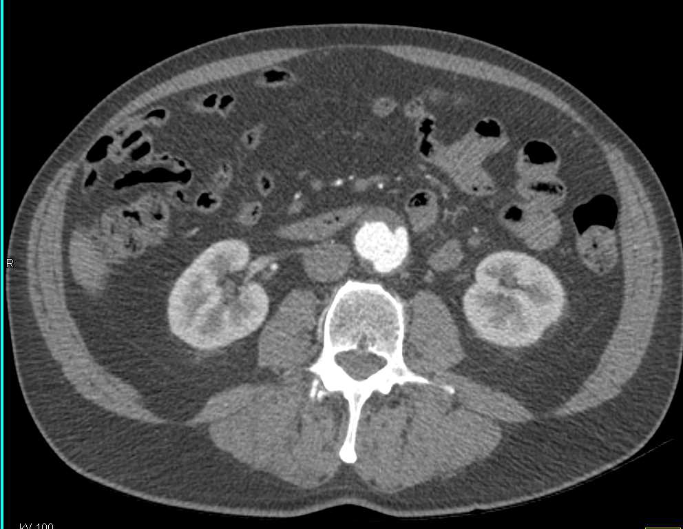 Type B Aortic Dissection - CTisus CT Scan