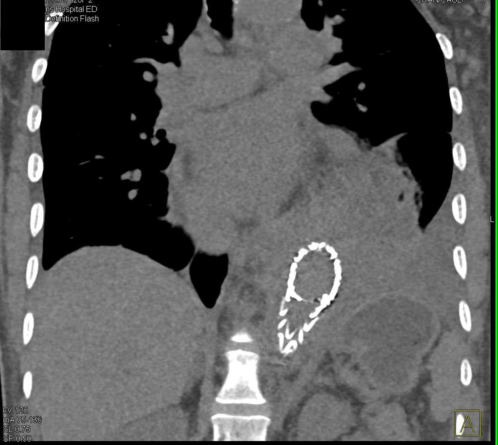 Endovascular Outpouching of Thoracic Aorta Just Above Endovascular Stent - CTisus CT Scan