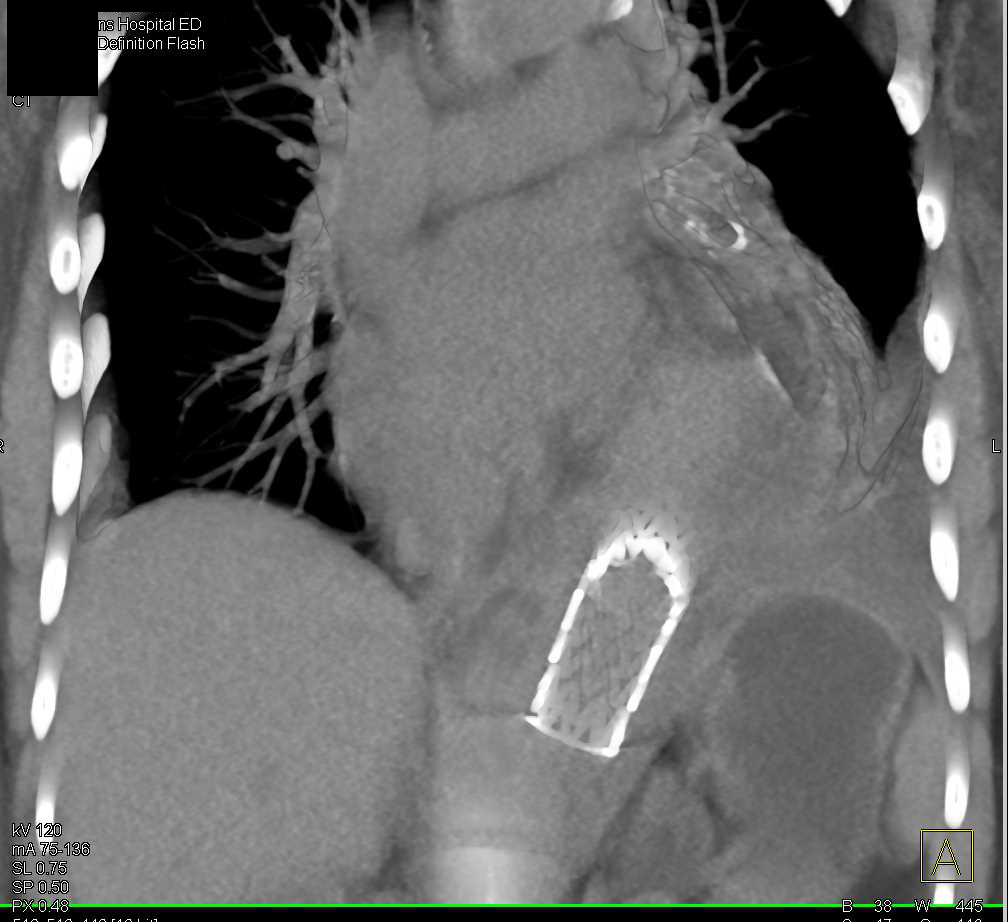 Endovascular Stent without Migration in Descending Thoracic Aorta - CTisus CT Scan