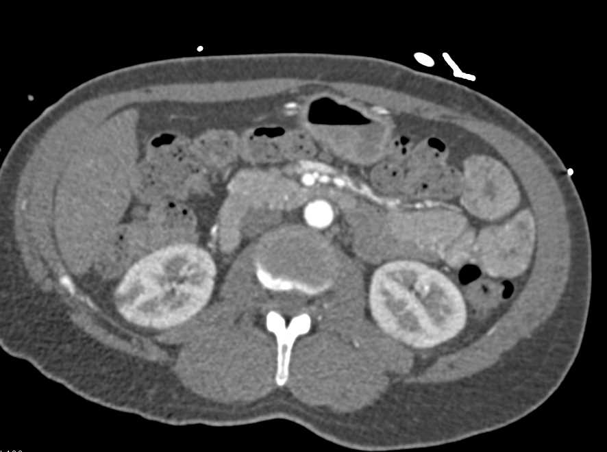 CTA Runoff with Right Popliteal Artery Occlusion - CTisus CT Scan