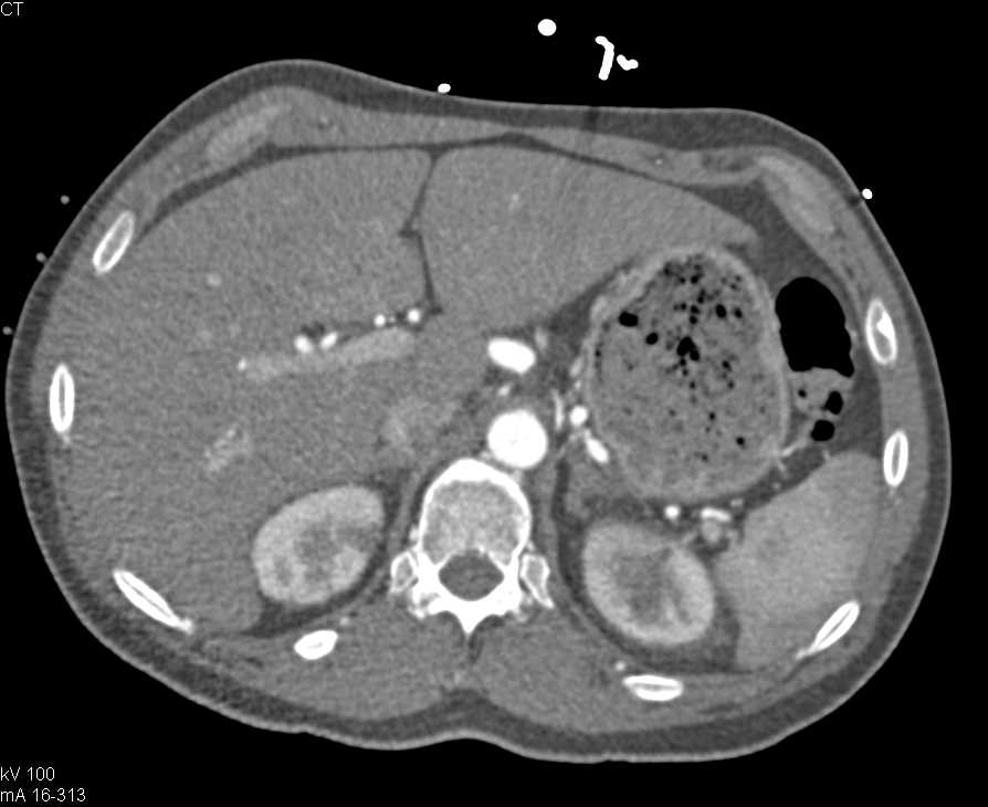 CTA Runoff with Right Popliteal Artery Occlusion - CTisus CT Scan