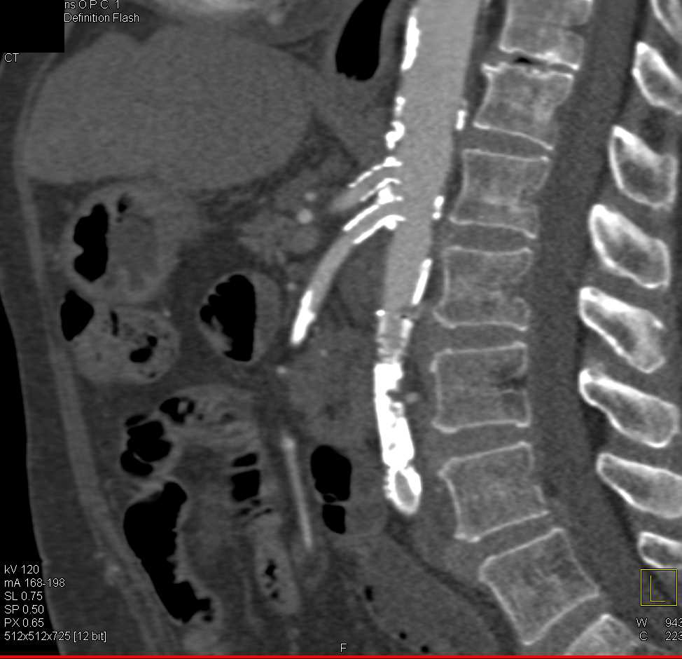 Patents Stents in Superior Mesenteric Artery (SMA) and Celiac Arteries - CTisus CT Scan